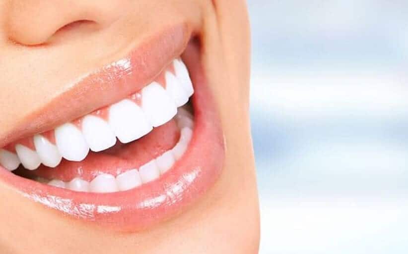 Caso de éxito de Carillas Dentales